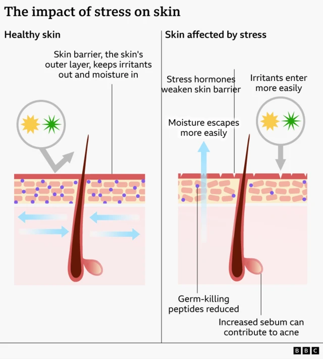 Graphic showing the difference between healthy skin and skin affected by stress. In the skin affected by stress, the outer barrier of the skin is shown with small breaks in it, and the brick-like structure of the cells beneath it is disordered, allowing moisture to escape and irritants to enter more easily.