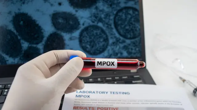 எம்பாக்ஸ் - கோவிட் 19 வேறுபாடு என்ன?