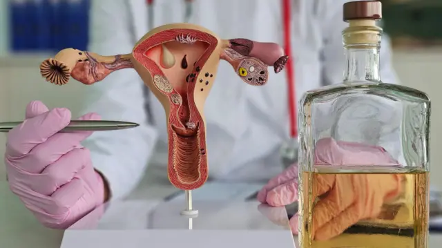 கருப்பை நார்த்திசு கட்டி