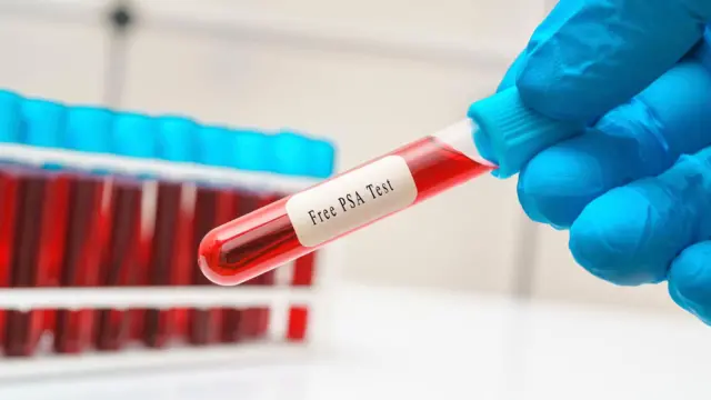 آزمایش خون سرطان پروستات