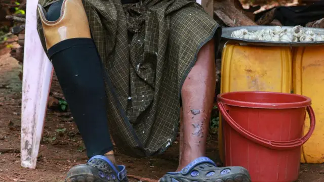 ကရင်ပြည်နယ်ထဲမှာ မြေမြှုပ်မိုင်းနင်းမိပြီး ခြေတစ်ဖက်ဆုံးရှုံးသွားသူတစ်ဦး