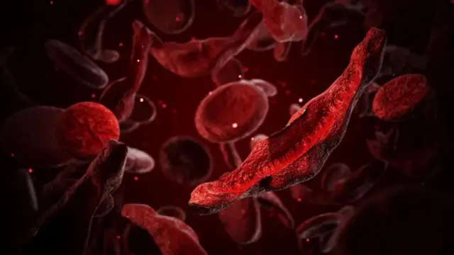 CRISPR технологияси айрим мамлакатларда ўроқсимон ҳужайрали анемия каби касалликларни даволаш учун маъқулланган бўлса-да, ҳозирча у жуда қиммат ва чекланган доирада қўлланилаётган усул ҳисобланади.
