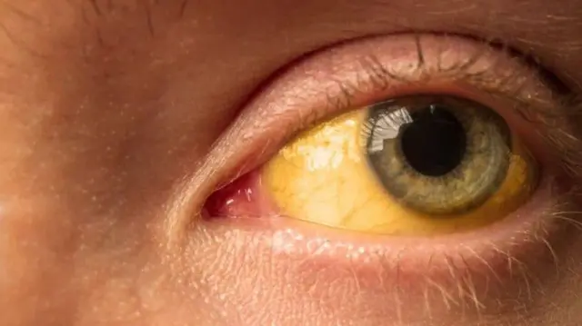 लिंवर कैंसर से प्रभावित आंख