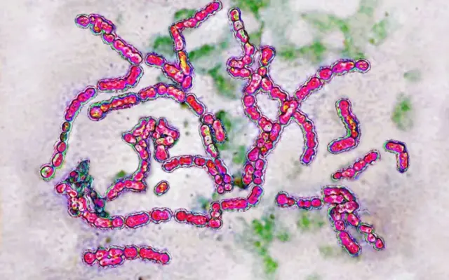 Les infections à streptocoques A sont une cause fréquente de maux de gorge chez les enfants.