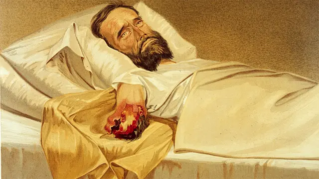 Un soldado de la Guerra Civil estadounidense con gangrena hospitalaria en el brazo (1861-65).