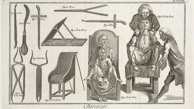 Grabado de cirujanos, pacientes e instrumentos del siglo XVIII