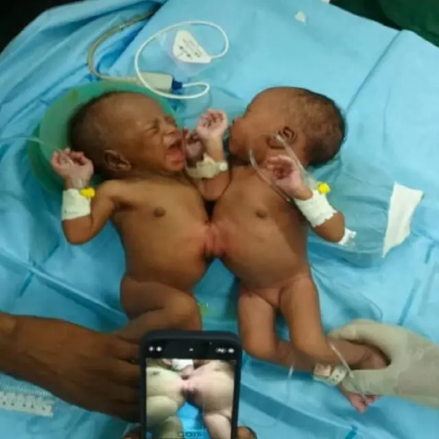 Waa dhacdo dhif ah in ay dhashaan carruur isku dheggan