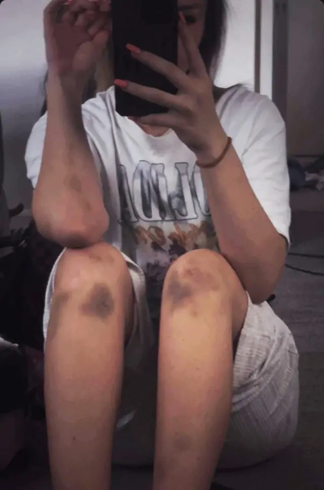 Selfie de Rebecca sentada, com o rosto encoberto pelo celular. Ela veste shorts cinza e apresenta hematomas escuros nos dois joelhos, além de marcas de hematomas nos braços