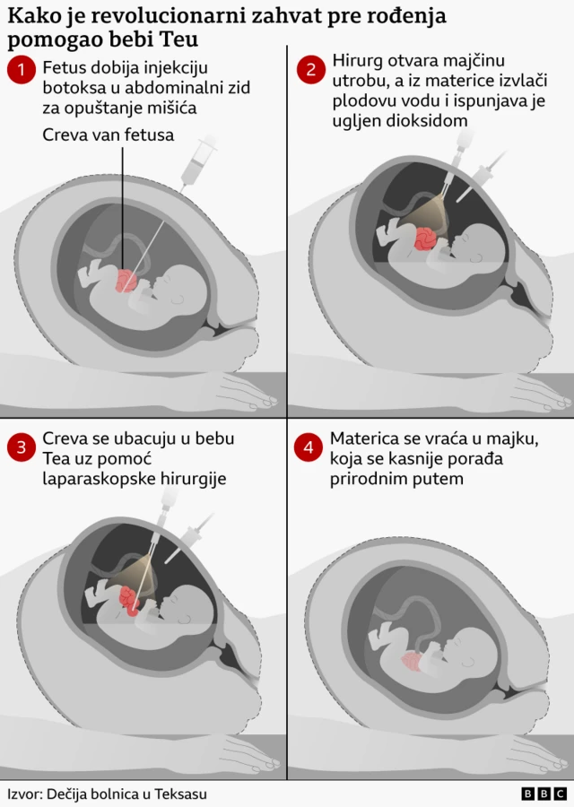 mapa fetusa u materici i načina na koji je izvedena operacija u četiri crteža