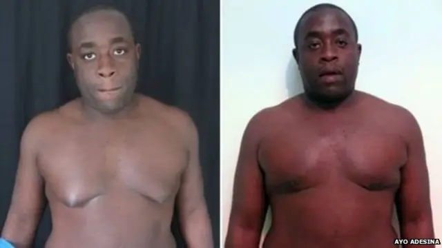 आयो एदेसिना के मैमल ग्लैंड्स बचपन से ही बड़े थे