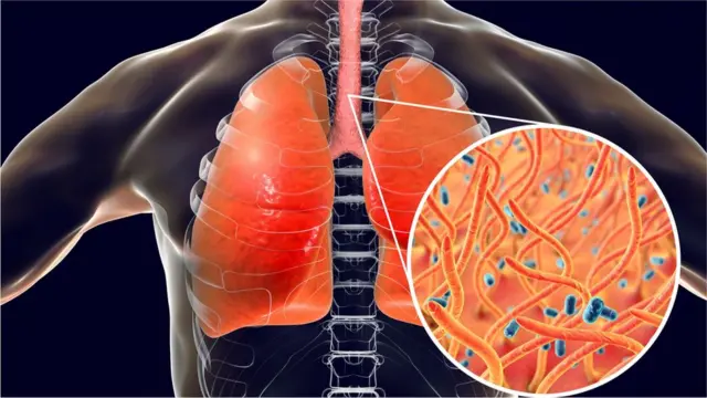 ડિપ્થેરિયાના જીવાણુ