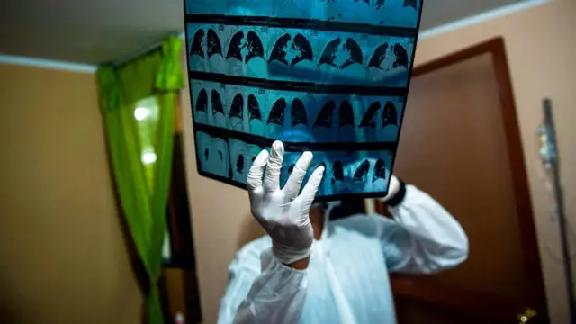 مرضى لديهم طفرة جينية يكشفون نقاط ضعف فيروس كورونا