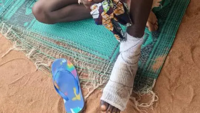 Victim of Buruli ulcer