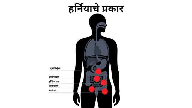हर्निया म्हणजे काय?
