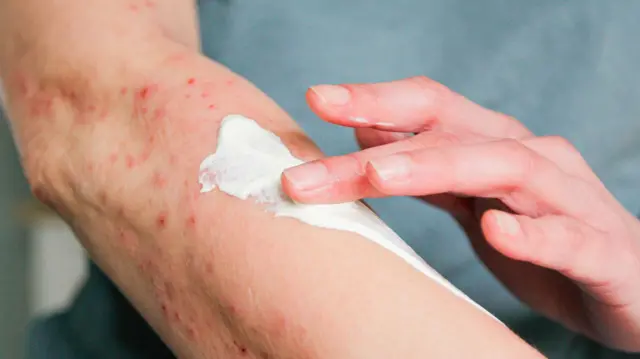 ப்ரோபயோடிக்ஸ் சிகிச்சை முறை என்றால் என்ன? சருமத்தில் பாக்டீரியாக்கள் இருப்பது நல்லதா? 