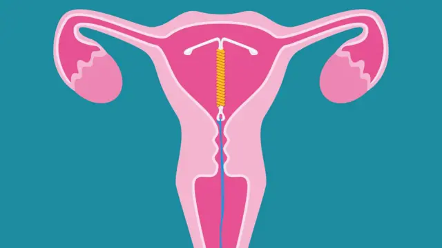 गर्भनिरोधक