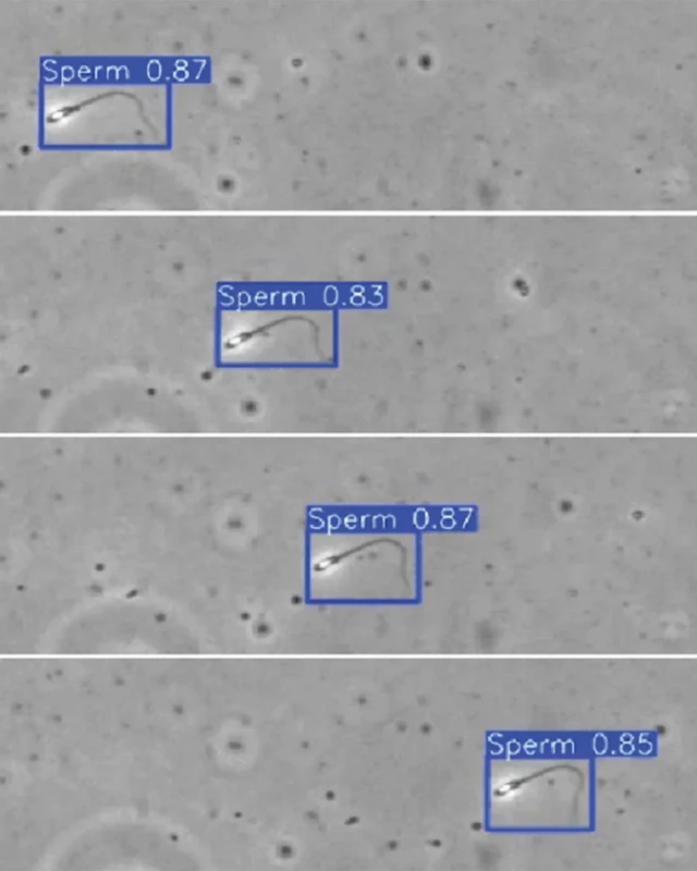 spermatozoid na četiri uzorka u spermi koja nema dovoljno semena
