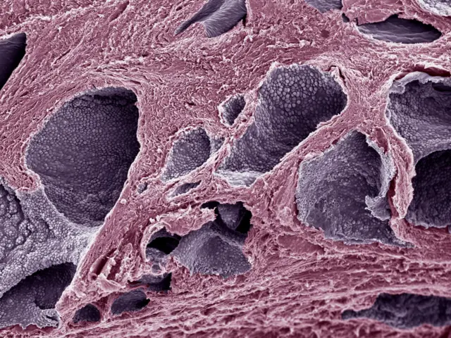 Células próstata cancerosas observadas bajo un microscopio electrónico