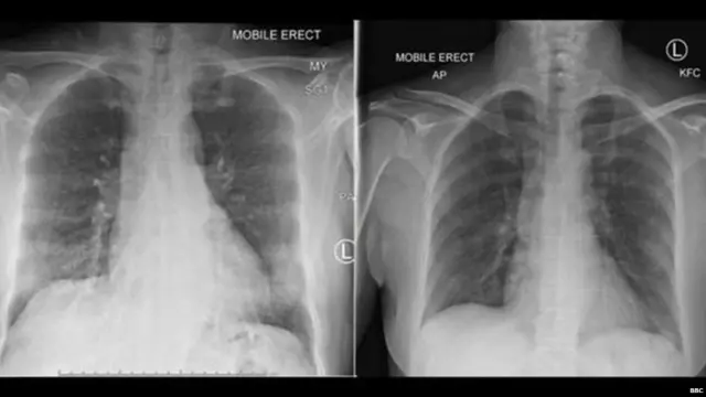 इम्यून सेल्स के आने के बाद मरीज़ की छाती