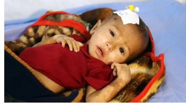 Yemen'de yaşları 5'ten küçük 1 milyon 800 bin çocuk yetersiz besleniyor
