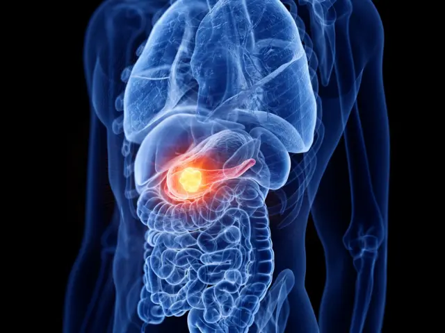 Pancreatic Cancer स्वादुपिंड, इन्शुलिन, कर्करोग, Insulin
