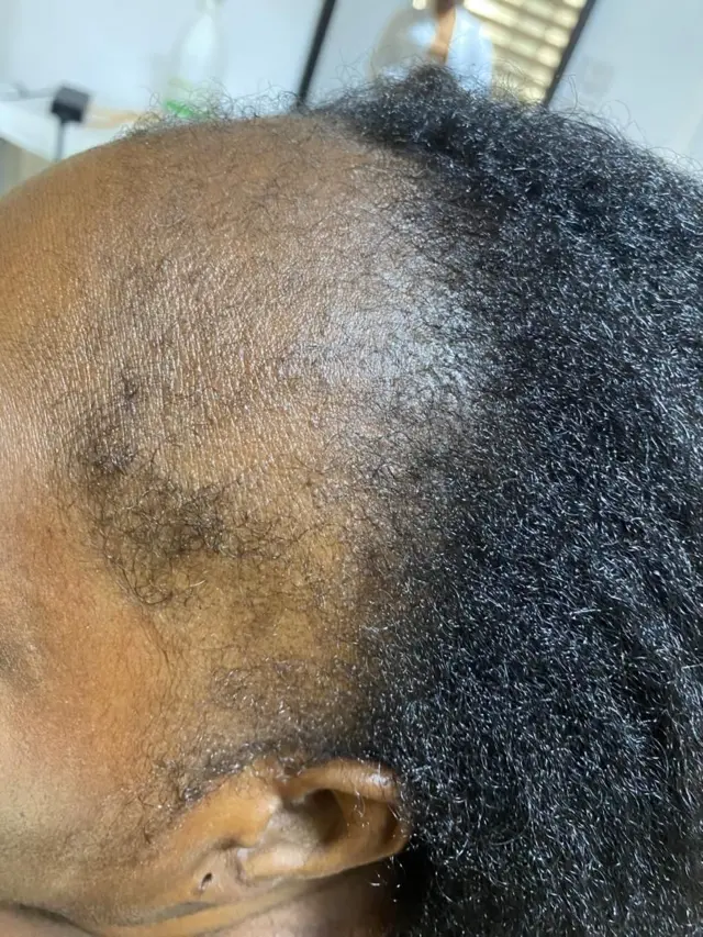 Tête d'une femme avec les chute des cheveux de devant