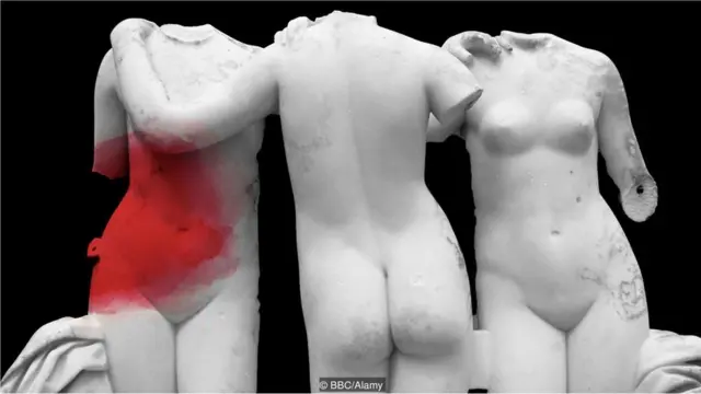 ఎండో మెట్రియాసిస్ endometriosis