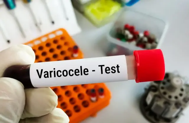 व्हेरिकोसिल झालेल्या प्रत्येकाला उपचाराची गरज असते का?