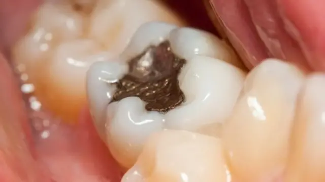 பல் சொத்தையை நிரப்புதல்