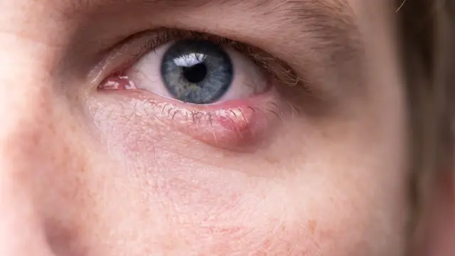 Hombre con ojo infectado