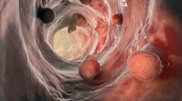 ਬਵਾਸੀਰ ਅਤੇ ਗੁਦਾ ਦੇ ਕੈਂਸਰ ਵਿੱਚ ਅੰਤਰ