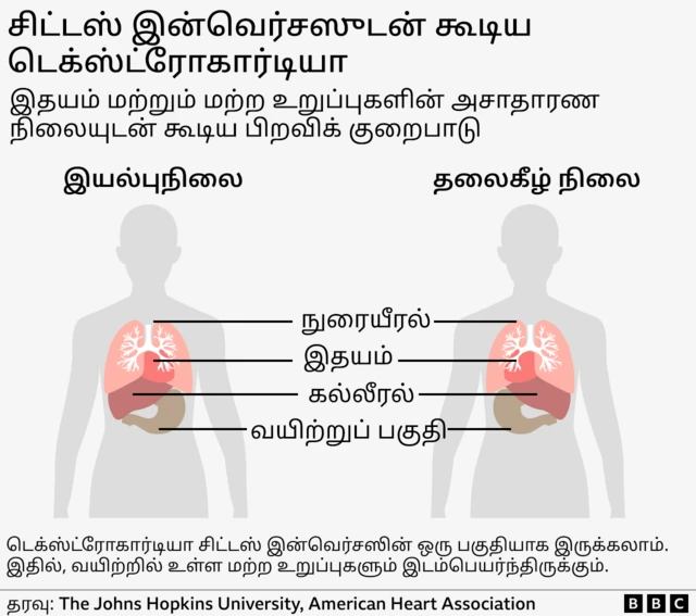 டெக்ஸ்ட்ரோகார்டியா