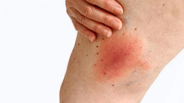 Mancha na pele causada pela doena de Lyme