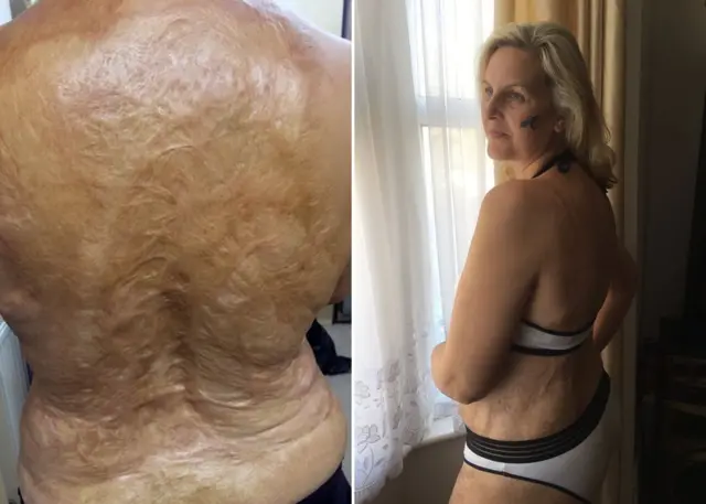 Sylvia Mac mostrando las cicatrices de su espalda.