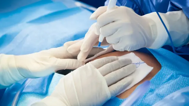 தாயால் முடியாத கட்டத்தில் மட்டுமே அரசு மருத்துவமனைகளில் சிசேரியன் பிரசவம் பரிந்துரைக்கப்படும்