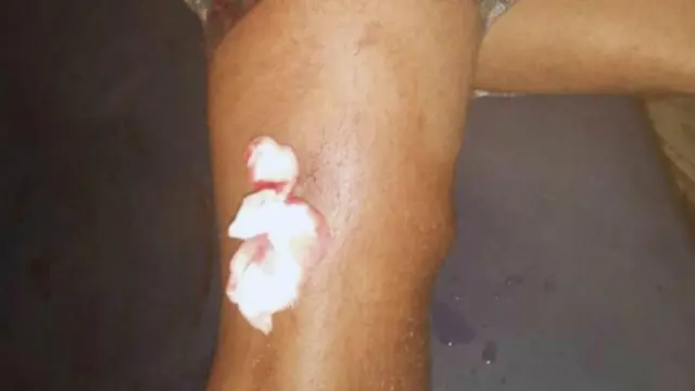 በዓዲጉዶም ከታጣቂዎች በተተኮሰ ጥይት እግሩ የተመታ ወጣት