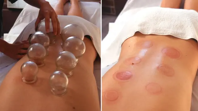 Cupping