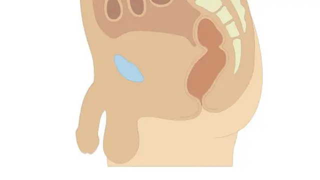 La longitud del pene tras la operación no varía con la erección.