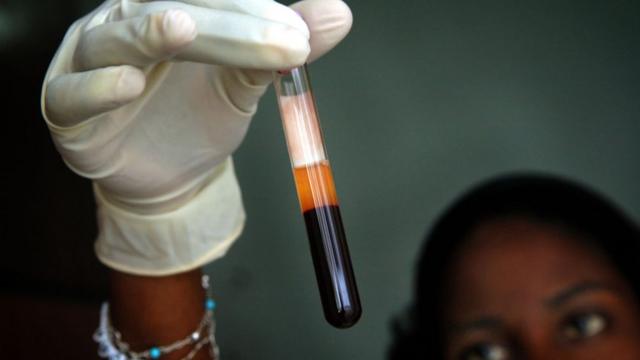 Woman dey look blood sample dem wan test for Zanmi Lasante Hospital, Cange Haiti