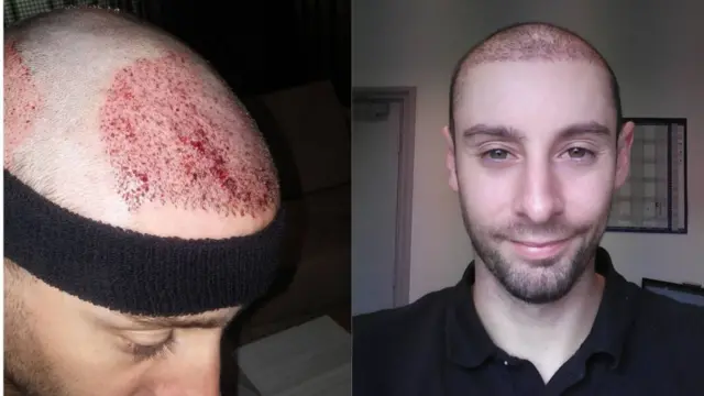 Chris do hair transplant in Turkey in 2016