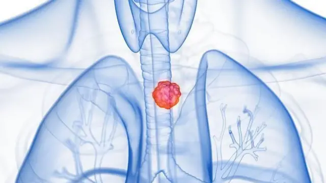 Cancer de l'œsophage