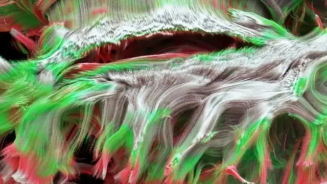 ภาพสแกนแสดงให้เห็นเส้นใยนำกระแสประสาท (แอกซอน) ในเนื้อสมองสีขาว (White Matter)