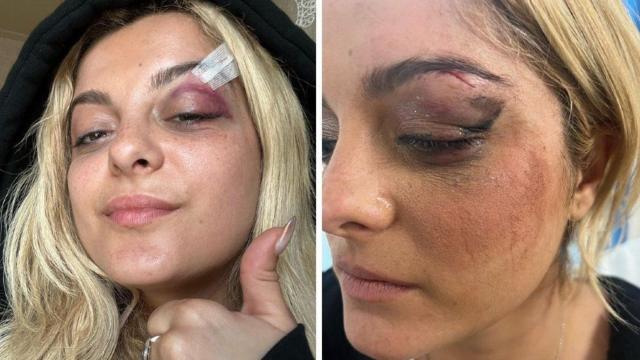Bebe Rexha mostrou seus ferimentosloterias caixa lotofacilum post no Instagram
