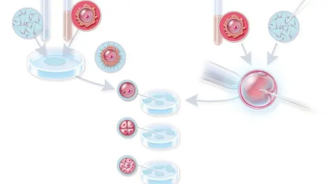 Schéma de la fécondation in vitro