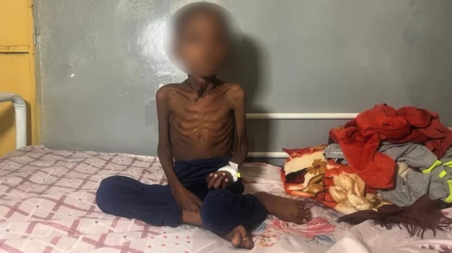 कुपोषण भएको बच्चा