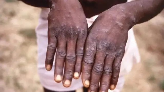 Calaamadaha Mpox waa ka mid ah Nabro 