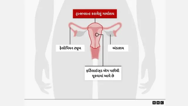 ટ્રાંસપ્લાન્ટ કરાયેલા ગર્ભાશય દ્વારા બાળક પેદા થયું, બ્રિટનનું પ્રથમ બાળક, હેલ્થ, મહિલા, બીબીસી ગુજરાતી