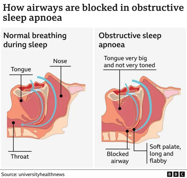 Sleep apnoea illustration - How airways are blocked in obstructive sleep apnoea