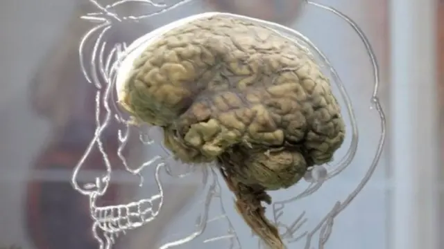 लोबॉटमी मेंदूचं शस्त्रक्रियाः डोळ्याजवळ टोकदार शस्त्र घुसवून केलेली मेंदूची शस्त्रक्रिया का लोकप्रिय झाली होती?