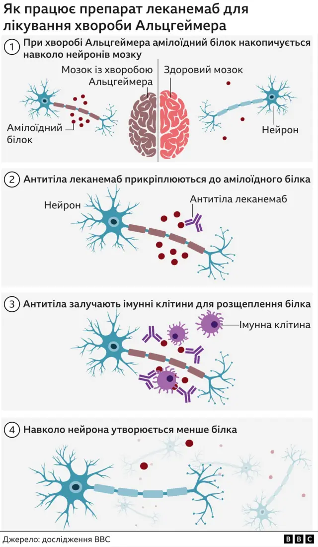 альцгеймер